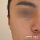 수원에스테틱 마이크로젯 시술 받고 온 후기, 에클라스킨 첫 방문
