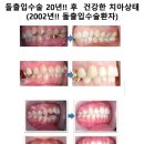 이재치과의원 | 돌출입교정 Vs 돌출입수술(ASO).?어떻게 달라요? 비용,가격,수술방법?