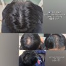 이끌린뷰티&어나더블랙두피페인팅두피염색스칼픽 | 대전두피문신리얼탈각후기,대전smp,둔산동두피문신(대전캐츠아이)