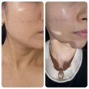 신사대화로 | [신사역피부과] 40대 리프팅 추천, 티타늄 리프팅 내돈내산 후기