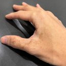 인천 청라 식물광피부염(Phytophotodermatitis) 을 아시나요?? - 베트남 여행 후 생긴 식물광피부염