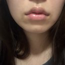 수포차 | 강남 입술필러, 이마 미간 보톡스 내돈내산 후기 (입술 필러 부작용? 입술 필러 후 하얀 수포)