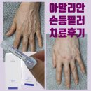 노바피부과의원 | 아말리안 필러 손등 주름 치료 후기