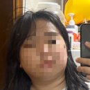 하이-얀 치과기공소 | 매복사랑니 4개 발치 나노후기, 사랑니 발치 비용