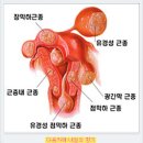 자궁경부암의 정의와 종류 이미지