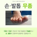 청주무좀 레이저 치료로 빠르게!