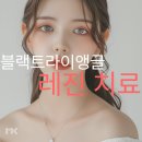 블랙트라이앵글 레진 치료(웃을 때 보이는 검은 삼각형)