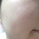 (주)토소웅 | 여드름 개선, 토소웅 어성초 페이스 토너 사용후기