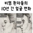 비염이 있으면 얼굴이 변하나요? 이미지