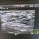 건강검진 유방촬영 후, 강남에서 유방초음파 그리고 조직검사 후기