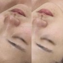 니들샷 진짜 효과 있을까?
