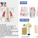 이상근 | 허리디스크 디스크내장증 스트레칭 후기(장요근,요방형근,이상근)