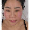 온다유도아카데미 | 피부과 온다리프팅 효과 부럽지 않은 대구 페이스리프팅 아미뷰티 대만족