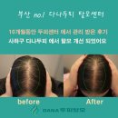 다나침 | 관리 받아도 소용없다는 말… 전/후 보면 말 바뀝니다 (사하구 당리 다나두피 리얼 후기) 알려드릴게요