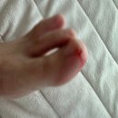 🩹손가락 살점 떨어진 후기 (+발가락 베임)🤕