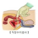 전립선암 (Prostate cancer) 이미지