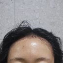 교약국 | 압구정 헤어라인 모발이식 내돈내산 후기 2700모 절개 수술 1일차 - 모발이식 지인할인 10% 추천인