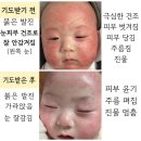 할렐루야!!! 장누수로 인한 우리 아이 피부에 새살이 올라오고 있습니다!!! 이미지