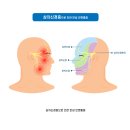 삼차 신경병증[trigeminal neuropathy] 이미지