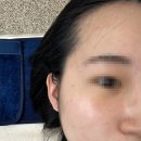 [내돈내산] 송파 본앤스킨 슈퍼젝션 소듐 하이알루로네이트 히알루론산 100% 후기