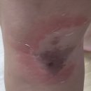 연세영피부과의원 | 모기 물린 곳이 부어 오르시나요? 성인 모기 알러지 후기(명의 연세영피부과의원)