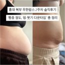 홍대 복부 무한람스 2주차 솔직후기 '통증 정도, 멍/붓기 다운타임' 총정리