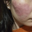 1회 사진기록전 | 상계동피부과 박스카 흉터 롤링성 여드름 흉터 치료 1회차 새살침 후기