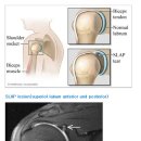 어깨 관절와순(labrum) 파열과 SLAP 병변 이미지