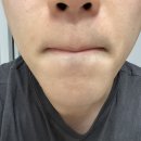 신촌 노벨의원 남자 얼굴제모 후기(비용, 부작용)