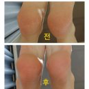 웰빙홈케어 | 여름철 발 각질제거 셀프케어! 웰빙헬스 고운발 풋크림 사용 일주일 찐후기