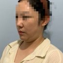 바라던 핏 | 신논현역 피부과 내돈내산 확연하게 달라진 얼굴 윤곽지방분해주사 바라던핏 후기 지방분해주사 추천