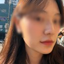 (주)한코교역 | 코뼈골절 비관혈적 정복술 한달 후기 (ft. 메부리코)