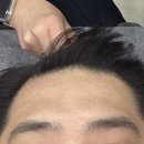 다산탈모치료 남자 탈모치료로 아르케 받은 후기(4회차!!)