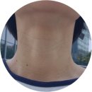 가로주름 | 가로 목주름 시술, 디어넥주사 솔직 후기 (다운타임까지)