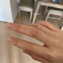 대구 광개토병원_손가락 화상치료 후기
