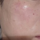 레아트성형외과의원 | [강남역 피부과] 도레성형외과의원 홍조 고민과 피부건조함