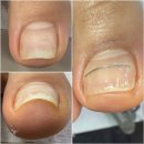 로띠끄 | 내성발톱 교정 형상기억합금 니토에 젤로랩 젤로띠끄 콤비 빠르고 안아픈 내향성교정방법 인천 논현역...