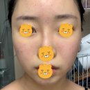 화안피부과의원 | 내돈내산 모낭염,좁쌀여드름 한의원후기...