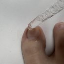 이지솔루션 | 발톱 곰팡이균 관리, 집에서 가능할까? 이지힐보이델라 퍼펙트케어 솔루션 앰플 솔직 후기