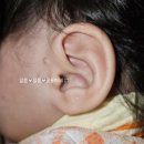 아이앤힐성형외과의원 | [육아일기] 스킨텍 제거_남양주 다산 아이앤힐 성형외과