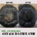 (주)가온기초이엔지 | 평택 정수리 탈모 고민 | 40대 남성 탈모 관리 6개월 관리 실제 후기