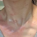 서울편평사마귀성지 신촌역피부과 유온느의원 / 편사제거 일주일 후기