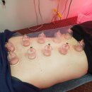 황제 쑥뜸 이미지