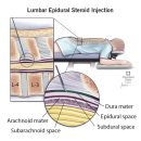 허리디스크 시술(epidural block) 탐구!! 이미지