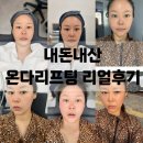 대구 동성로 피부과 내돈내산 온다리프팅 쌩 리얼후기 (보정❌)