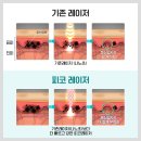 일본식 이레즈미 문신 제거
