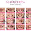 미니쉬 치아디자인, 라미네이트가 고민이라면? 이미지