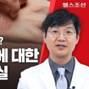 건선] 난치 질환으로 알려진 건선, 의학적 치료로 충분히 극복 가능해 이미지