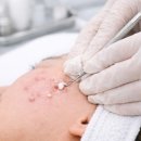 청담고운세상닥터지피부과의원 | 강남 여드름 치료 피부과, 압출 잘하는 곳이 중요합니다