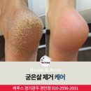 경기 광주 굳은살 제거 으뜸 b 1회만으로 케어 받아요